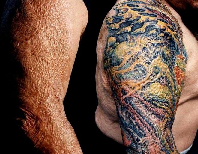 Tatouage sur les brûlures