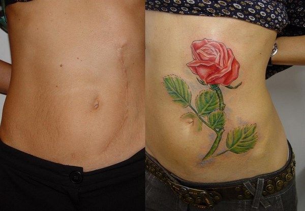 Tatouage sur les vergetures