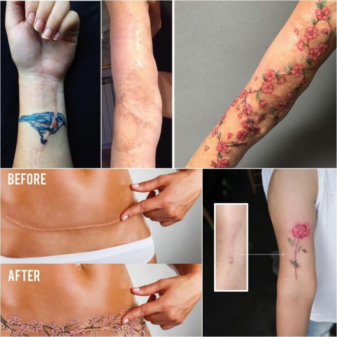 Tatouage sur cicatrices - Tatouage sur cicatrices - Tatouage sur cicatrices - Couverture de cicatrices