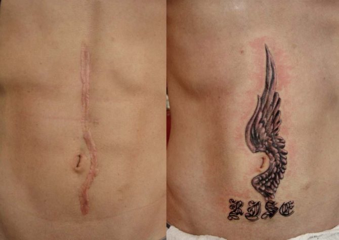 Tatouage sur les cicatrices