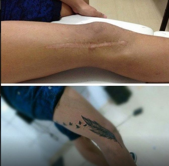 Cicatrice de tatouage sur la jambe