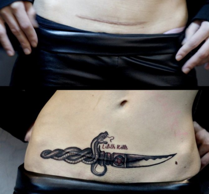 Tatouage de la cicatrice après une césarienne avec photo : quand peut-on le faire ?