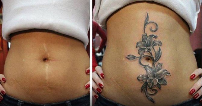 Tatouage sur l'abdomen cicatrisé