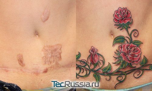 Un tatouage sur le ventre cache une cicatrice