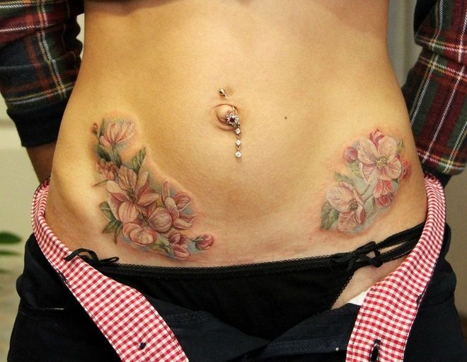 Tatouage après une appendicite