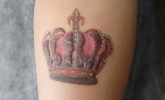 Cicatrices de tatouage et cicatrices kelmoïdales