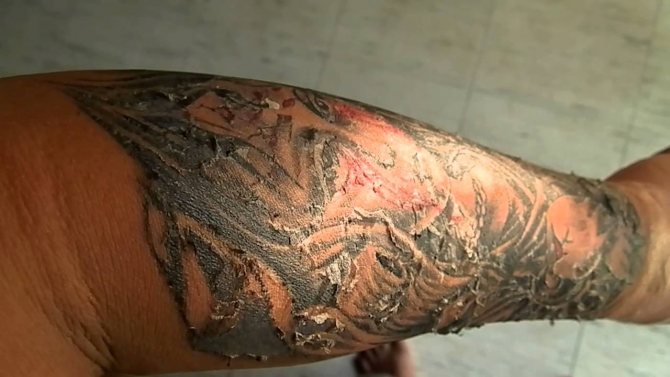 Peeling de tatouage : pourquoi et que faire ?