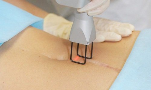 traitement au laser