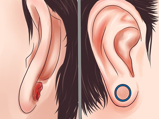 Des tunnels dans les oreilles des filles. Images, vergetures, soins