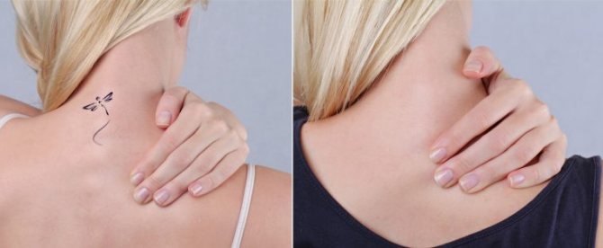 La suppression des tatouages avant et après