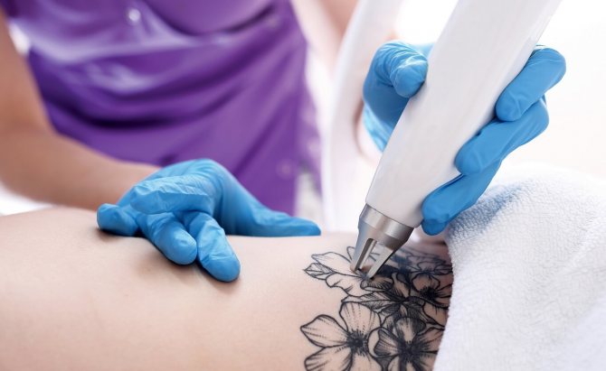 Suppression des tatouages au laser