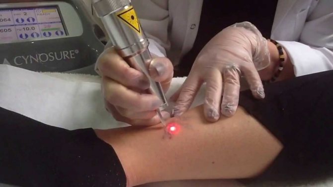 l'élimination des tatouages au laser