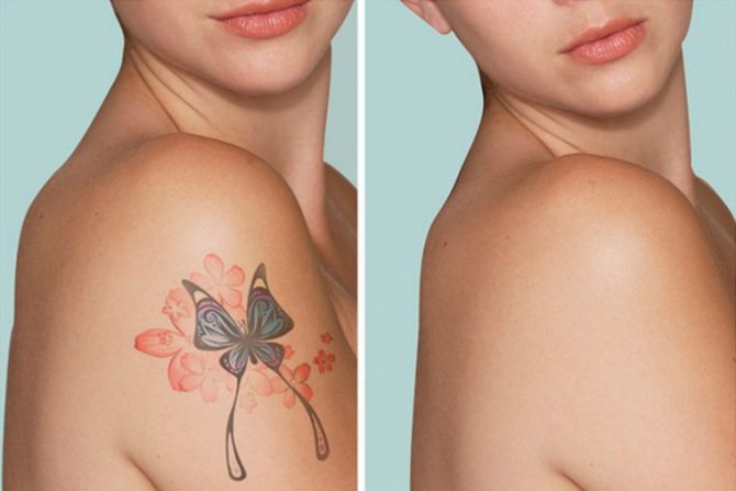 Suppression des tatouages