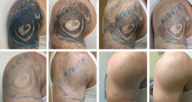 Suppression des tatouages7