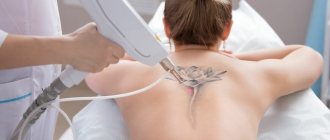 Enlèvement des tatouages au laser