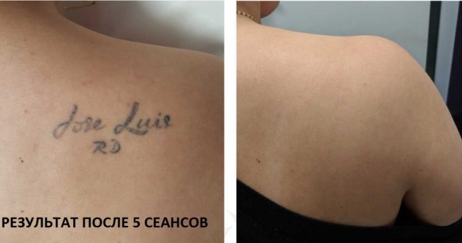 laser de détatouage