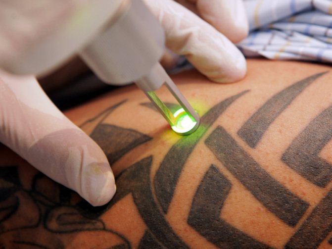 Détatouage au laser