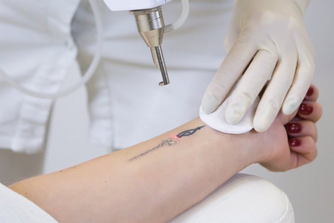 la suppression des tatouages
