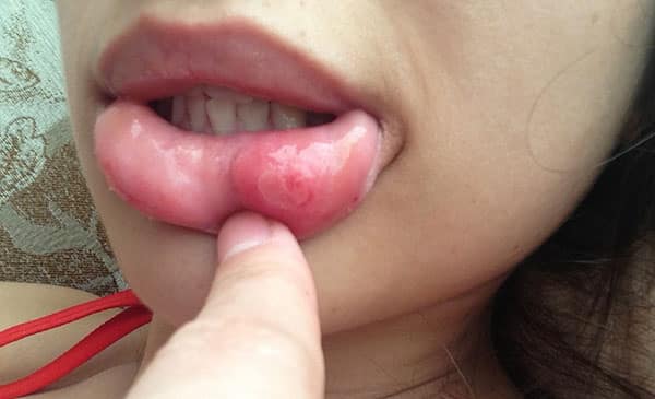 Inflammation du piercing à la lèvre