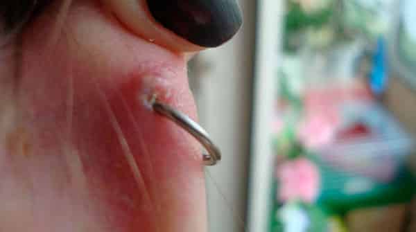 Inflammation des piercings d'oreille