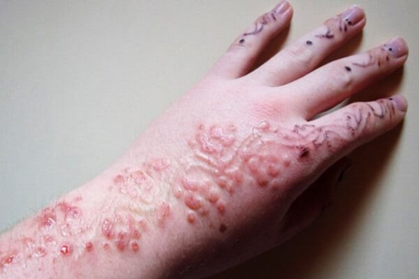 Complications possibles du tatouage au henné