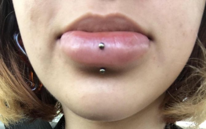 Conséquences possibles d'un labret vertical