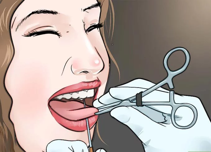 Tout sur le piercing de la langue : piercing, soins, conséquences possibles