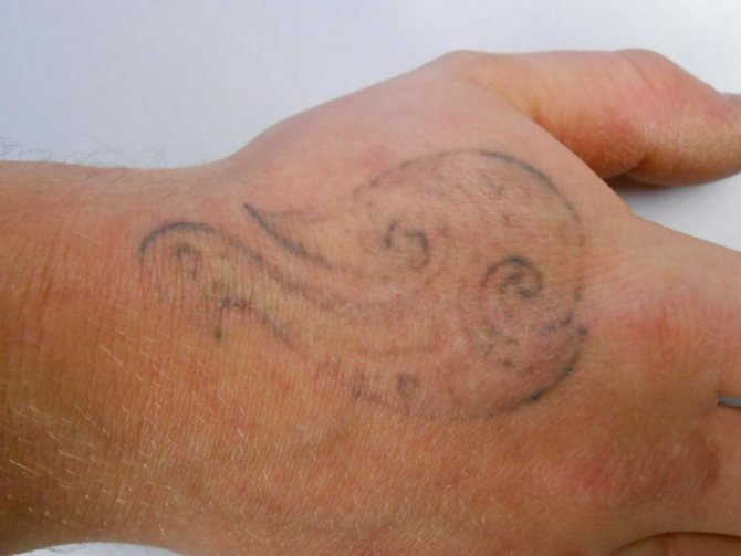 Enlèvement du tatouage sur le bras